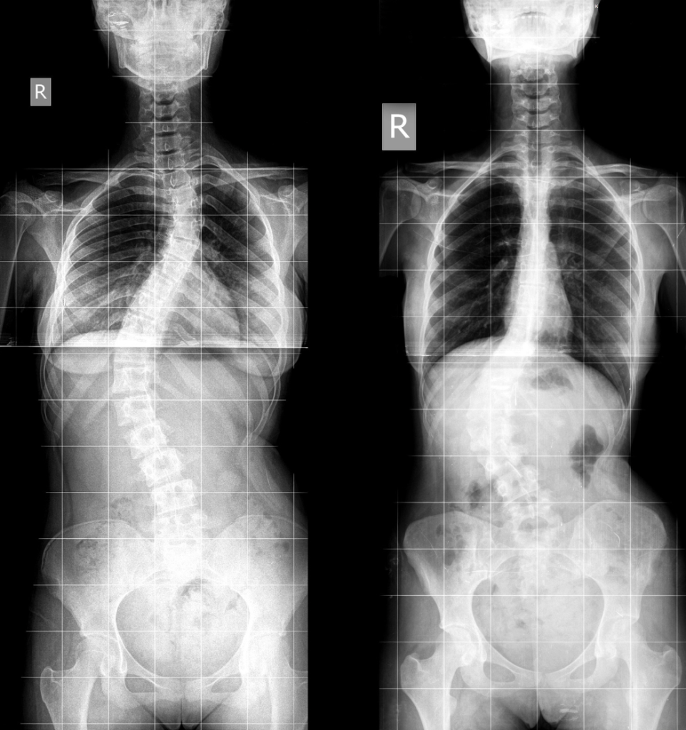 Scoliosis Angles