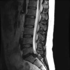 Disc Herniation