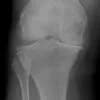 Osteoarthritis: Degnerative Disc and Joint Disease
