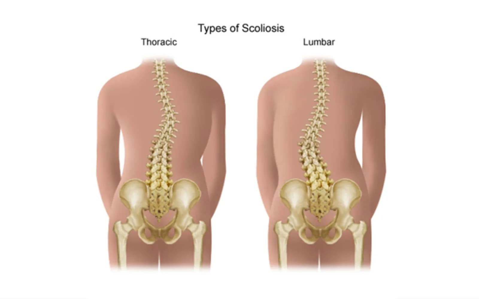 Scoliosis Pain
