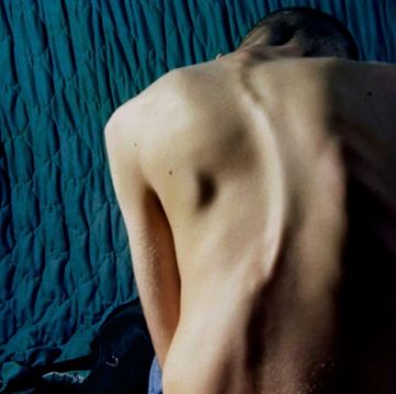 back pain from scoliosis