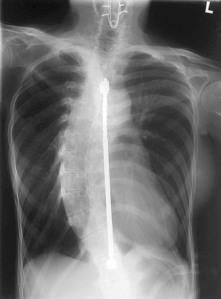 scoliosis back x-ray