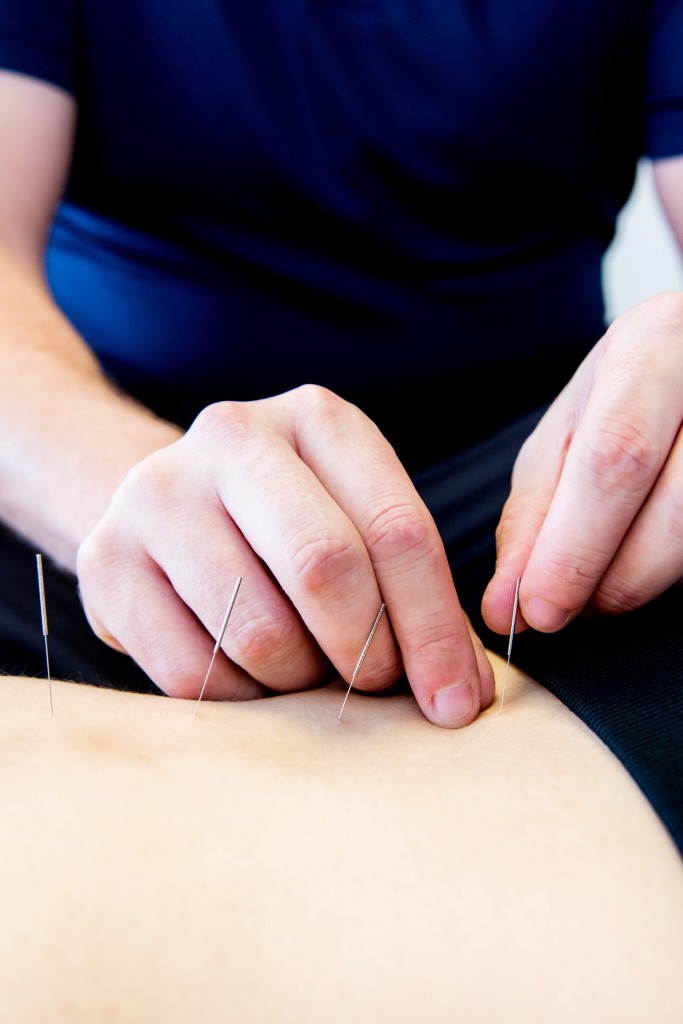 Acupuncture treatment