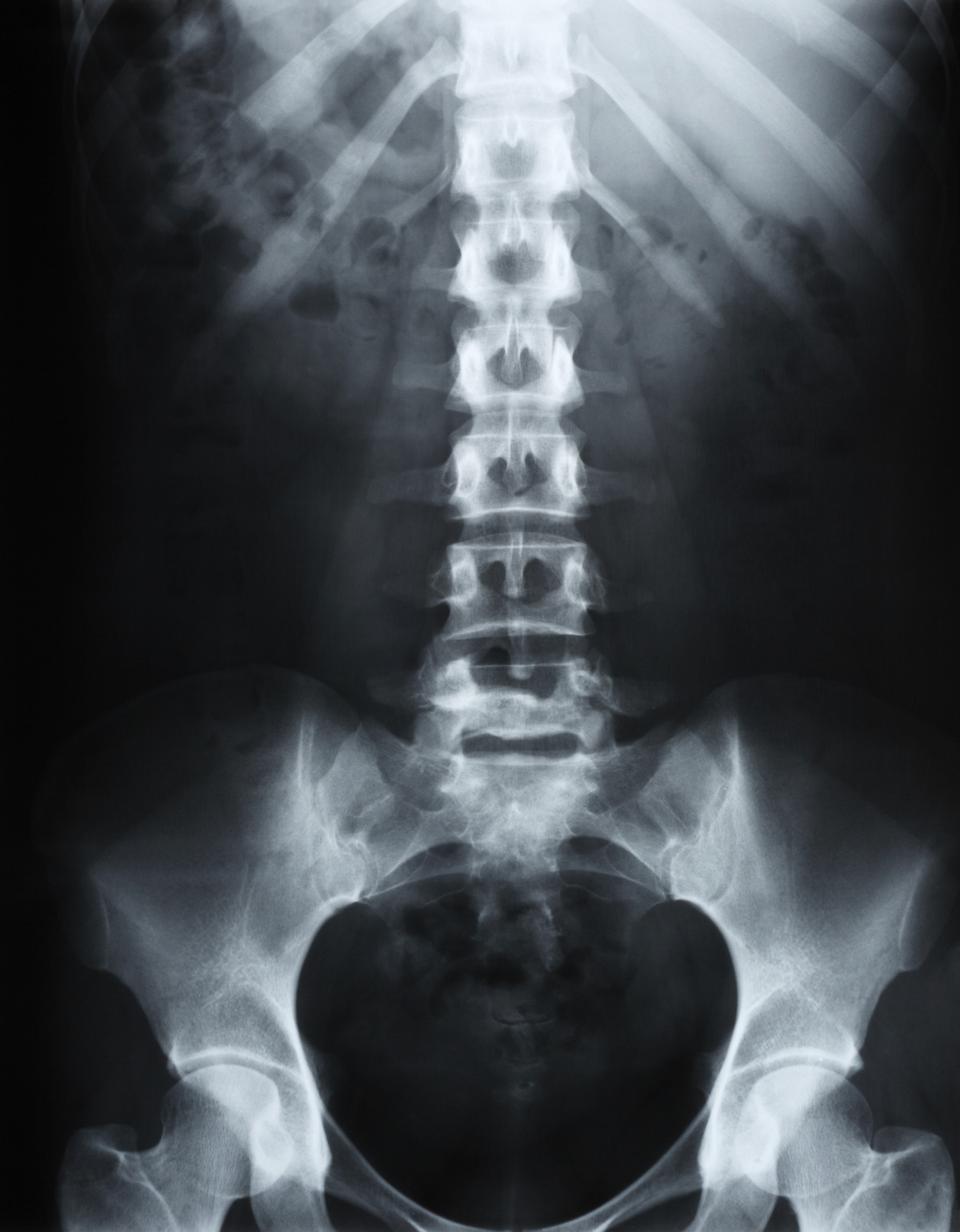 Low Back Pain: Should I Get X-ray Imaging?
