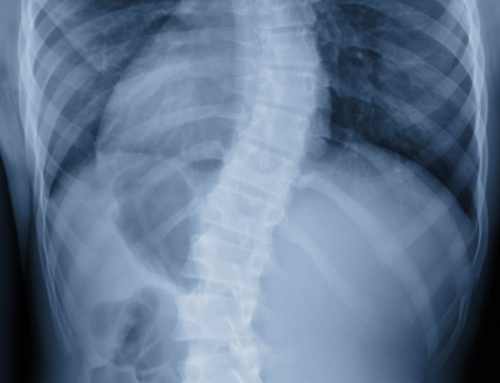 Setting the Record Straight on Idiopathic Scoliosis